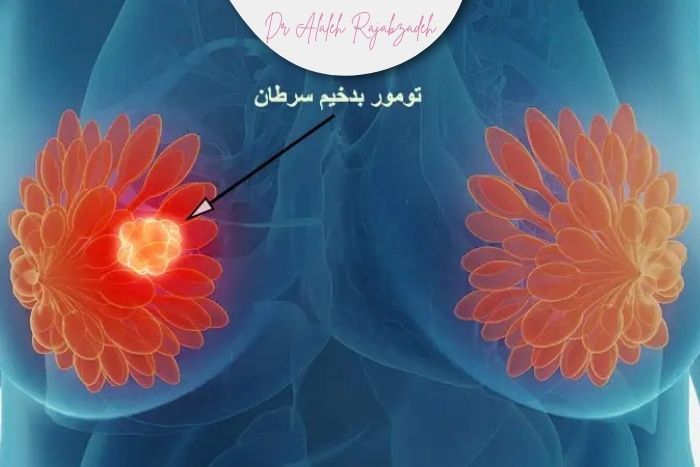آیا تمام توده‌های پستان نیاز به بیوپسی دارند؟