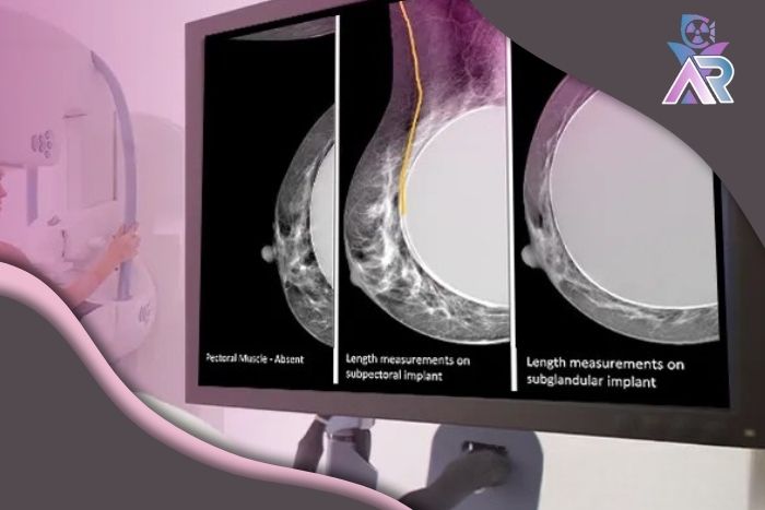 ماموگرافی در افراد دارای پروتز سینه؛ نکات مهم و مراقبت ‌ها