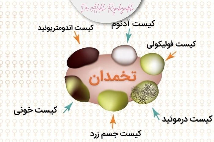 انواع کیست های تخمدان