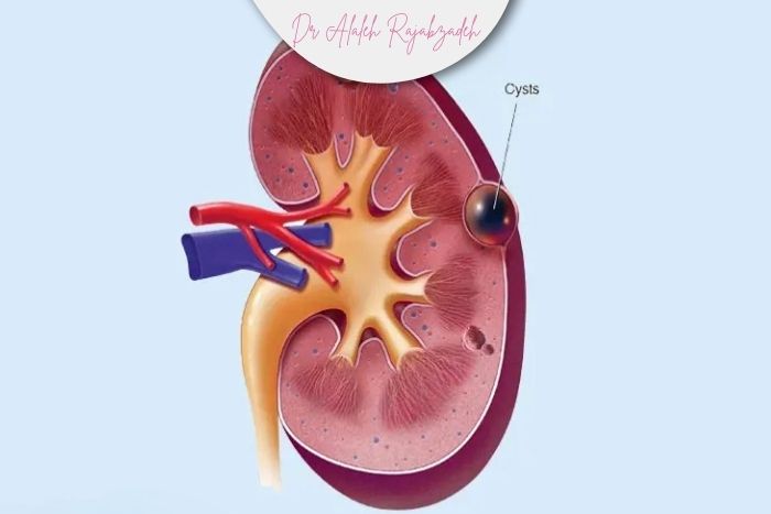 منشأ و علل ایجاد کیست‌های ساده