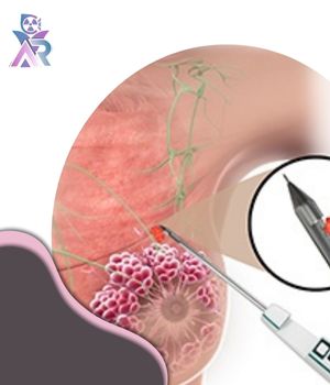 چه نتایجی از بیوپسی به دست میآید؟ چه نتایجی از بیوپسی به دست میآید؟
