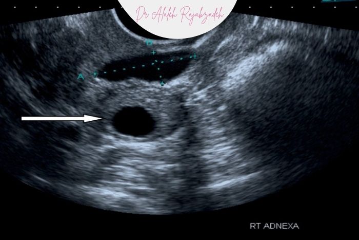 پیگیری کیست‌های ساده در اندام‌های مختلف بدن